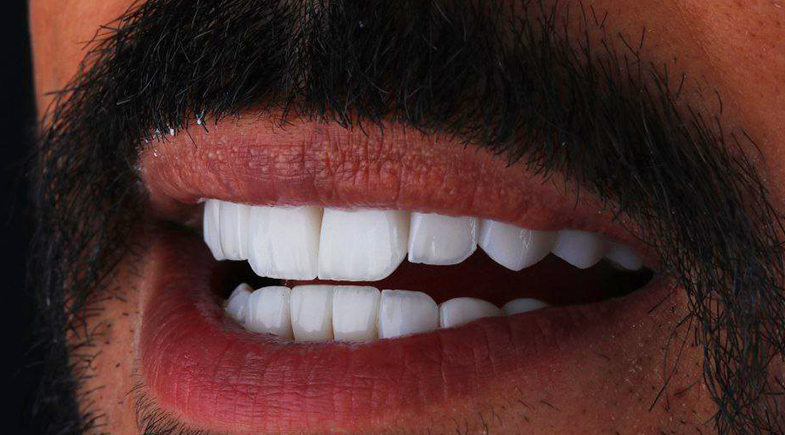 Hollywood smile cover