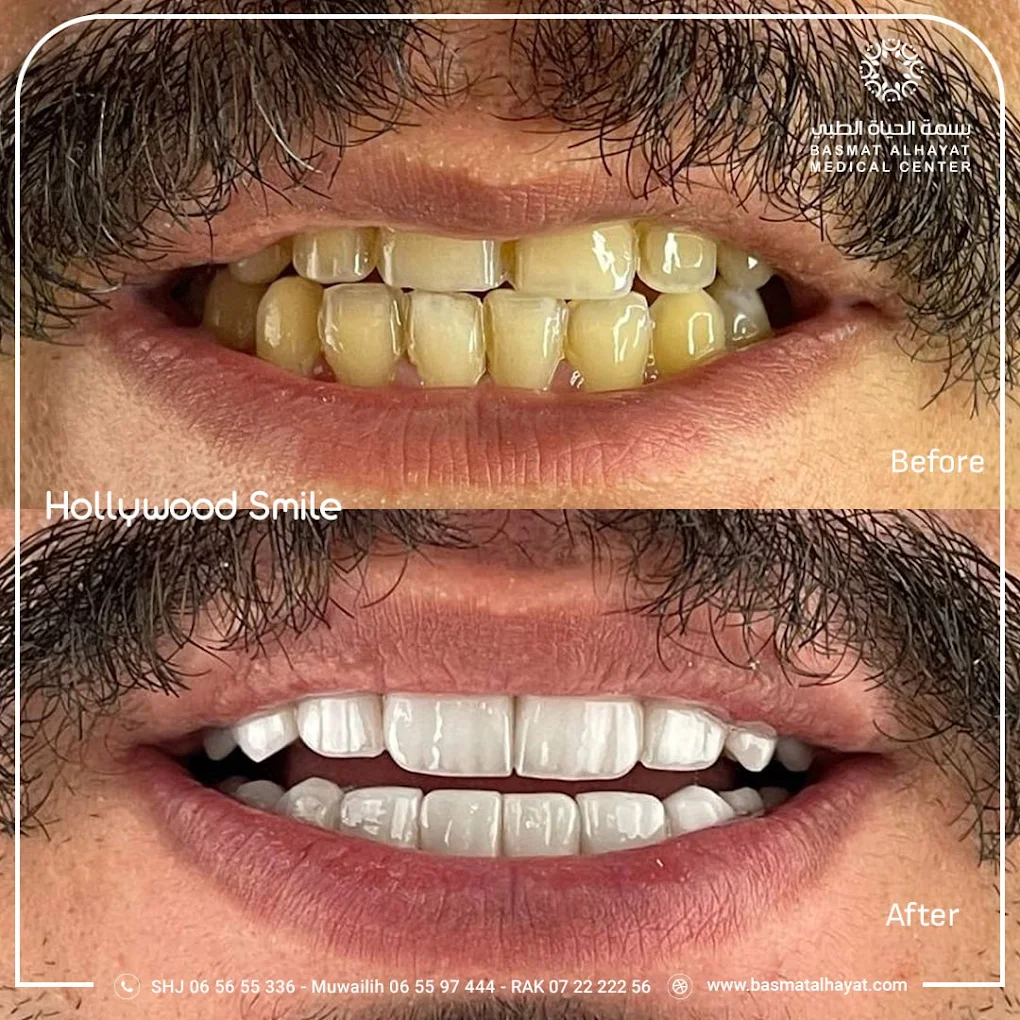 hollywood smile - basmat alhayat