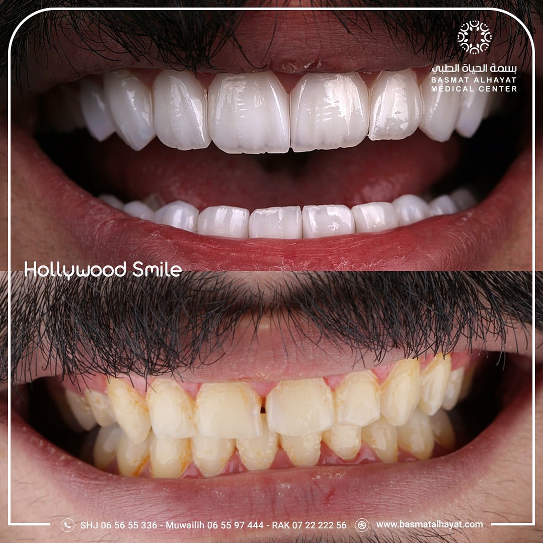 hollywood smile - basmat alhayat