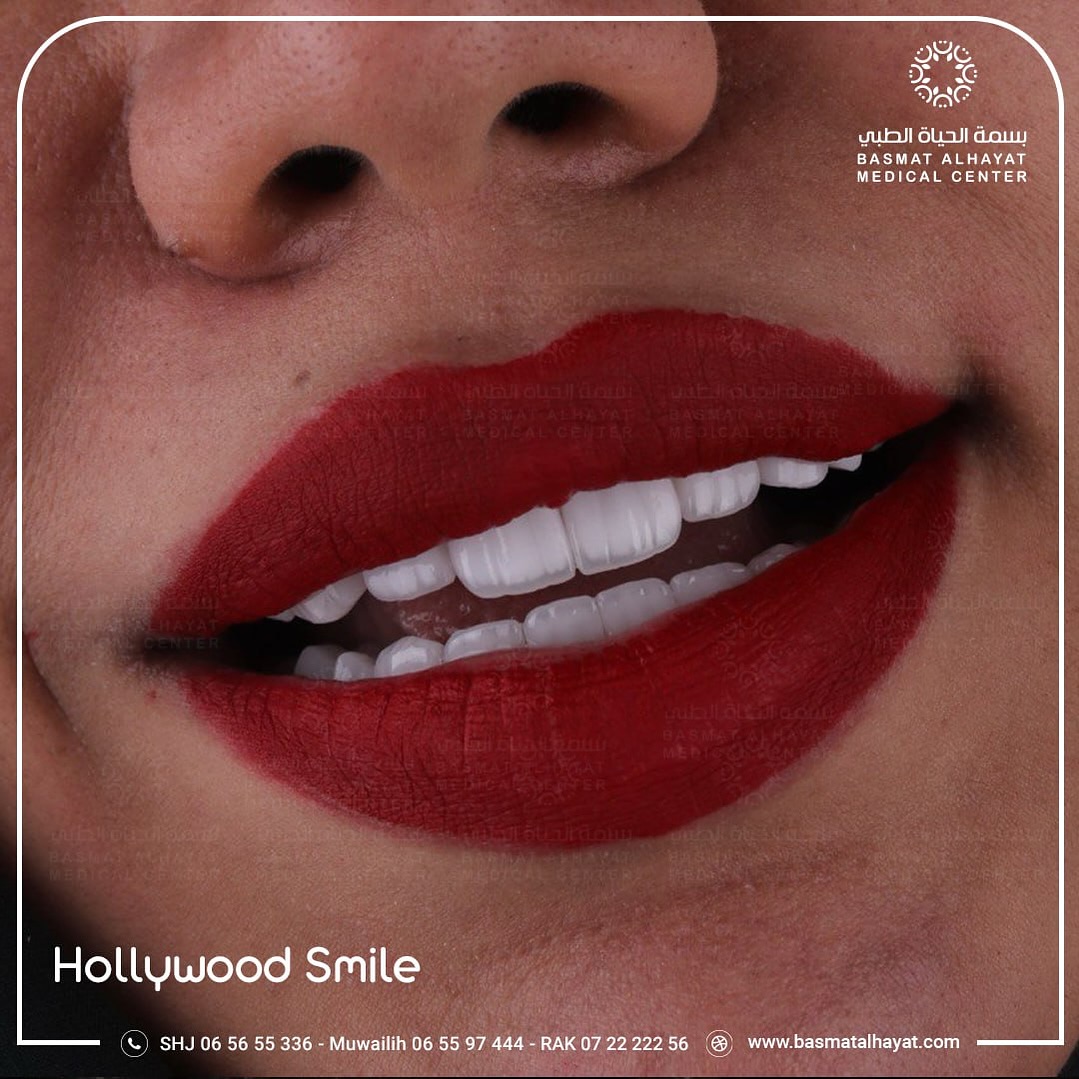 hollywood smile - basmat alhayat