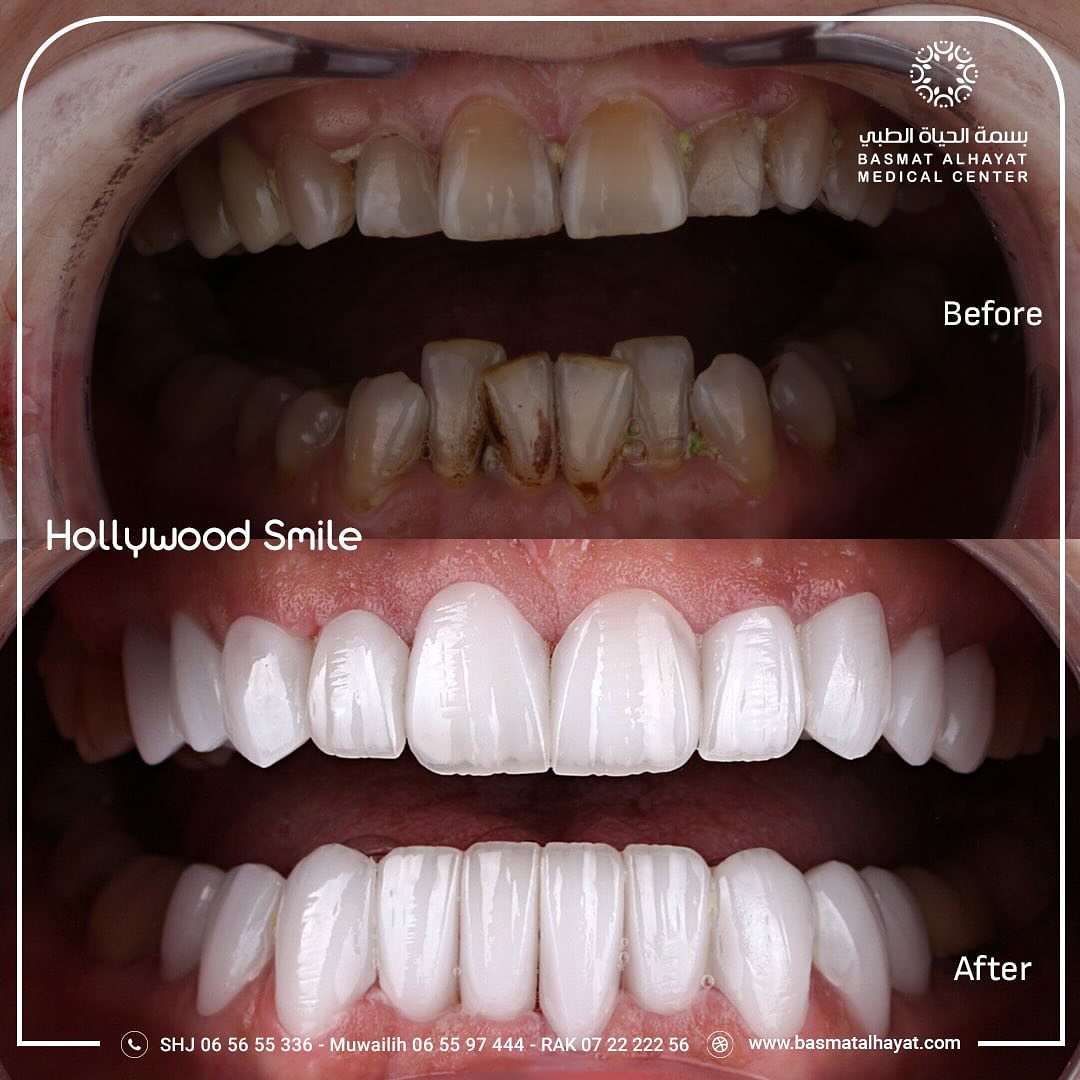 hollywood smile - basmat alhayat