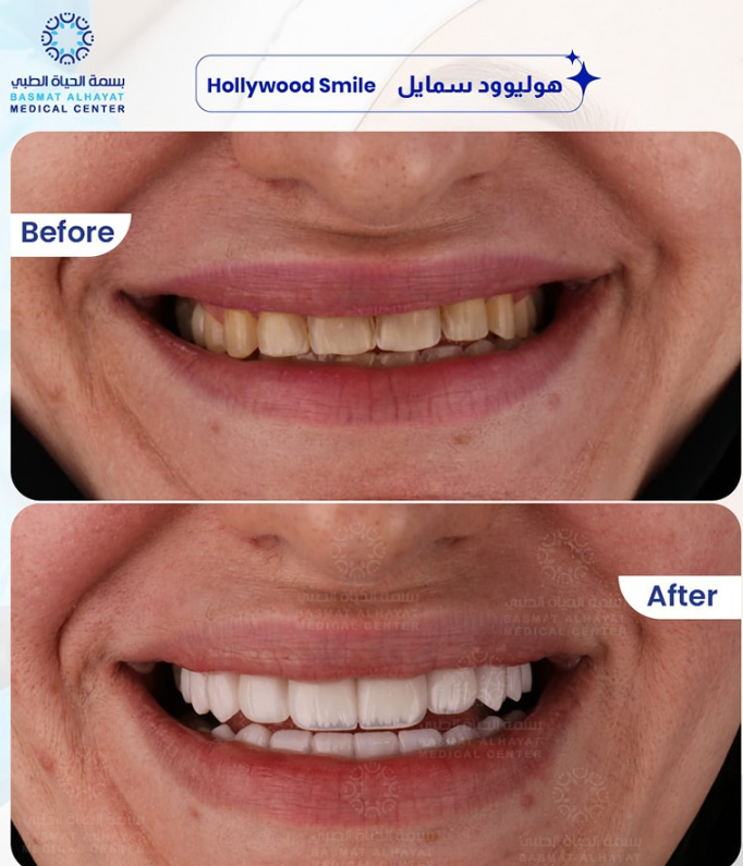 Hollywood Smile Sharjah before and after