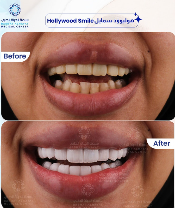 Hollywood Smile Sharjah patient with cosmetic dentist