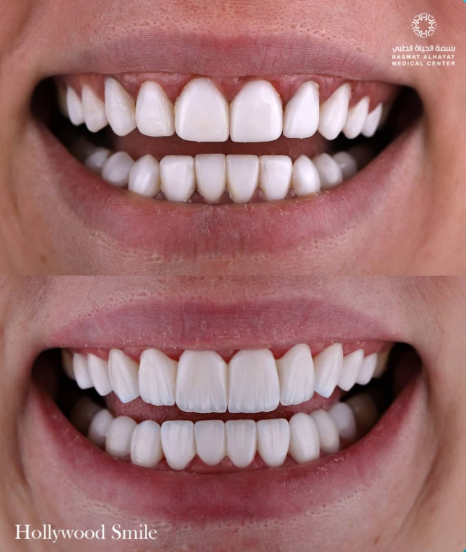 Hollywood Smile Sharjah natural veneers