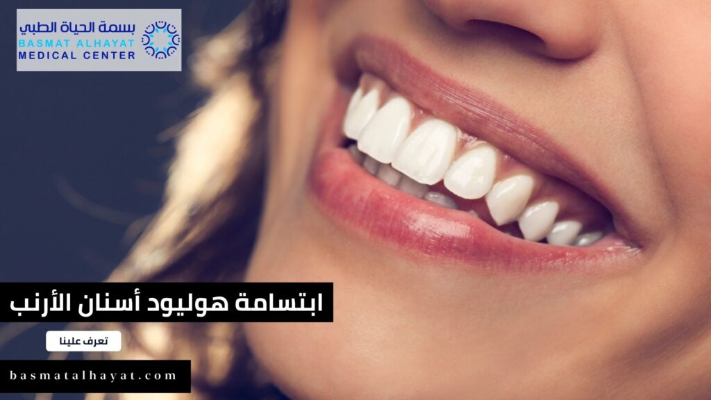 ابتسامة-هوليود-أسنان-الأرنب-1-1024x576