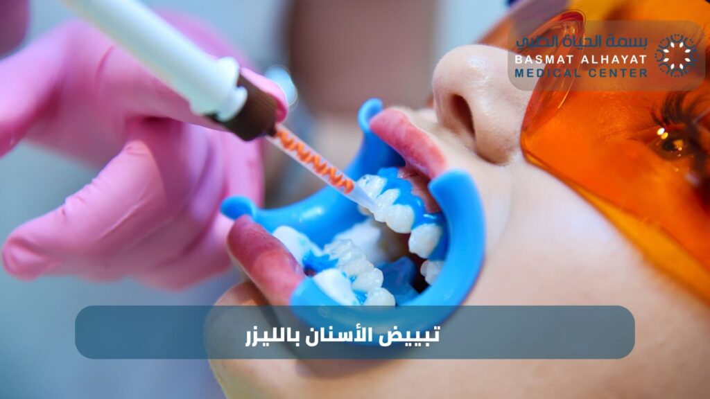 تبييض الأسنان بالليزر