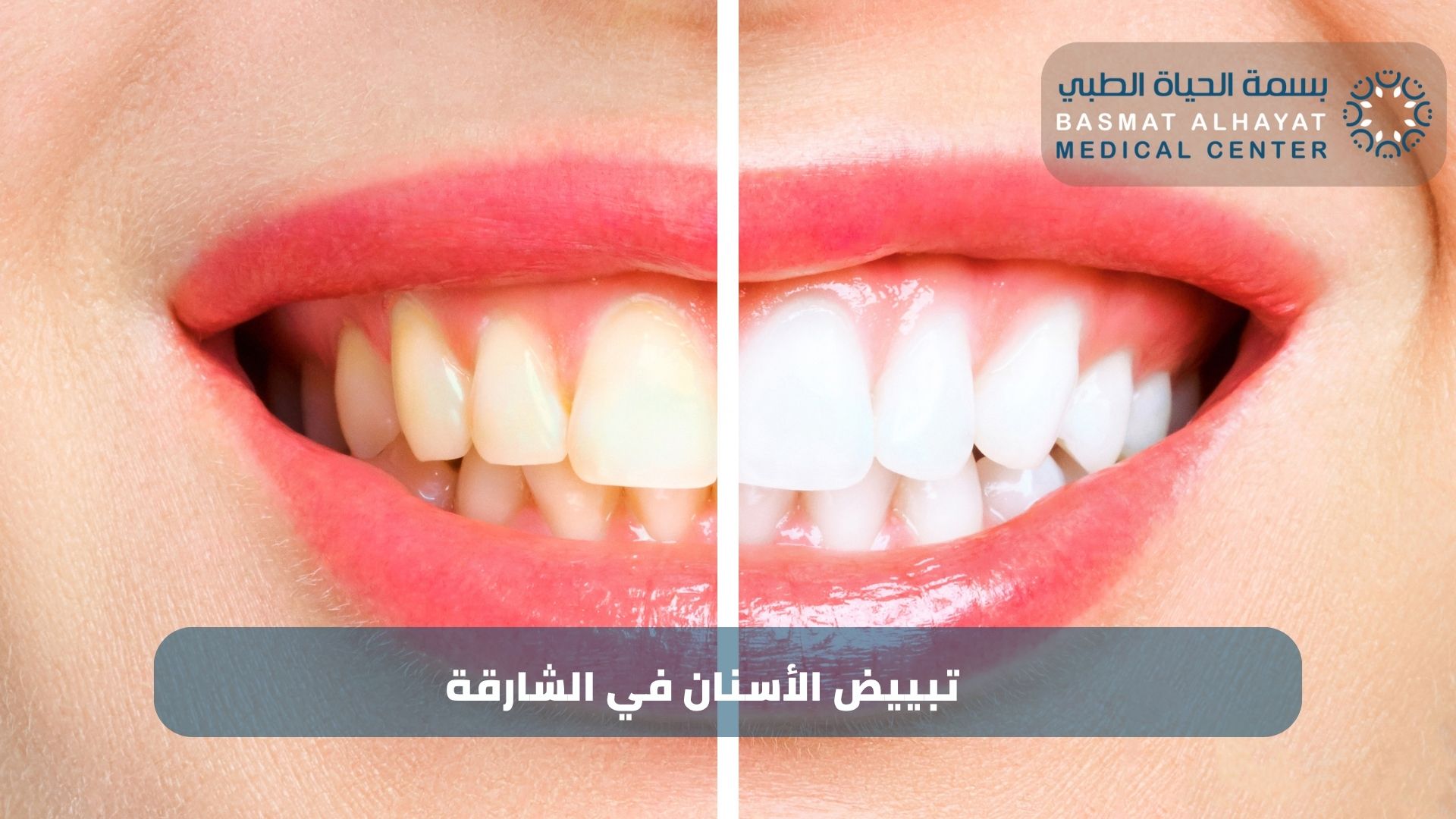 تبييض الأسنان في الشارقة – دليلك الشامل مع مركز بسمة الحياة
