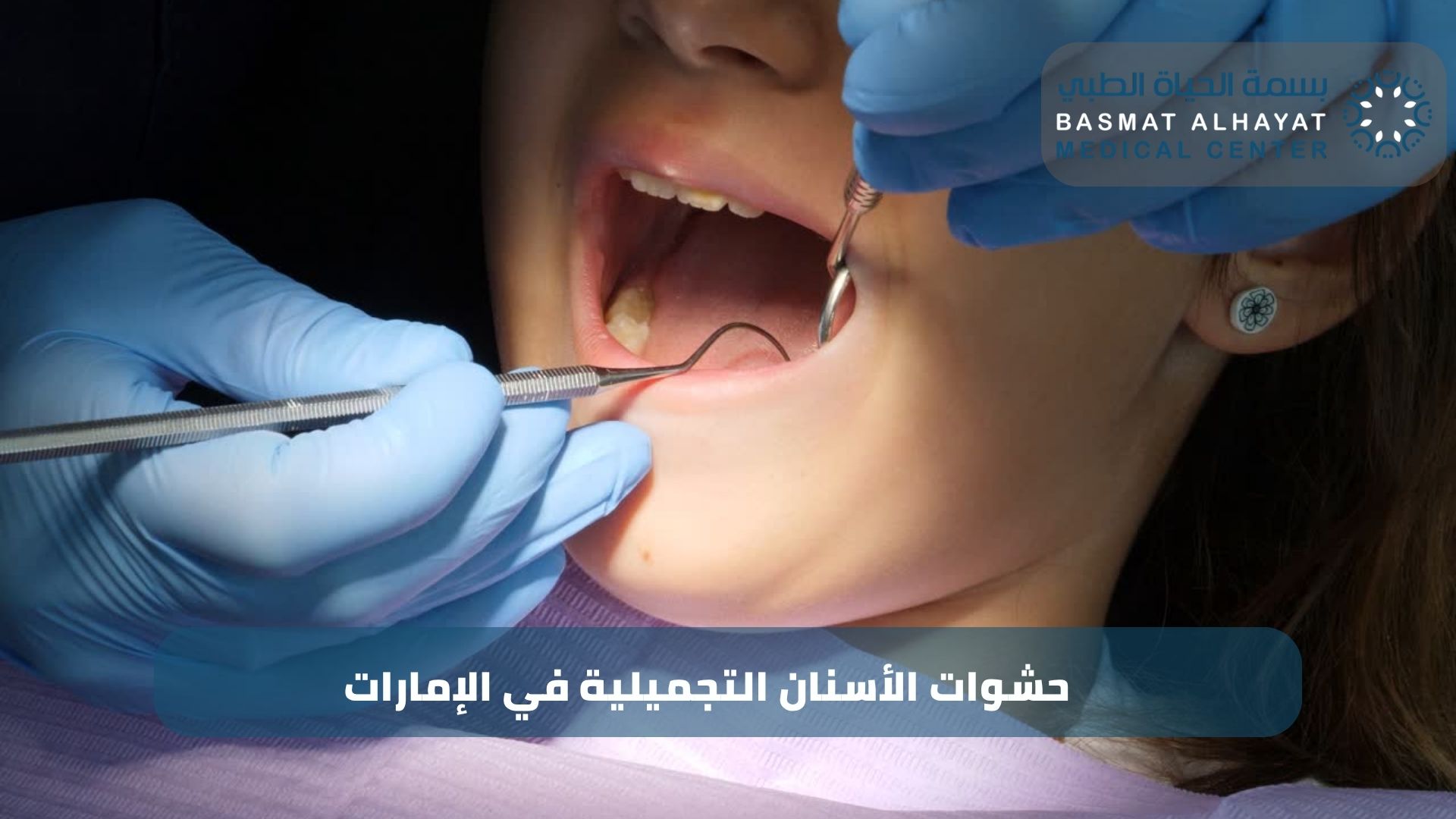 حشوات الأسنان التجميلية في الإمارات – دليلك الشامل مع مركز بسمة الحياة