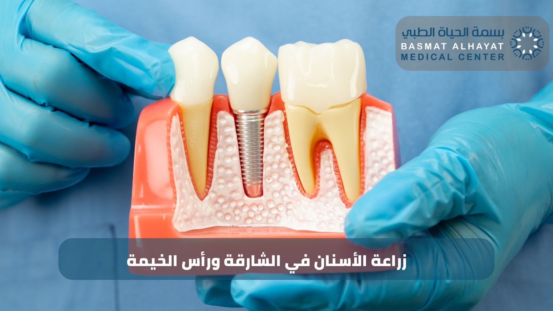 زراعة الأسنان في الشارقة ورأس الخيمة