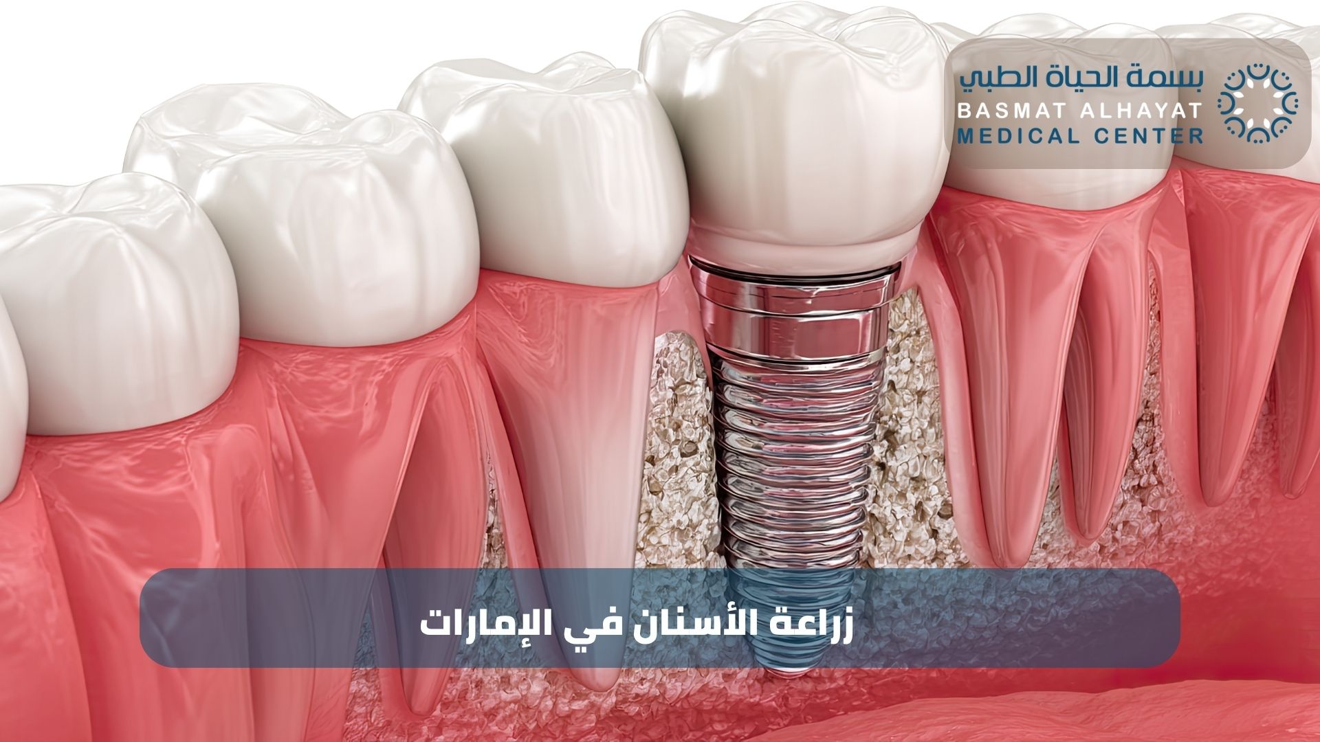 زراعة الأسنان