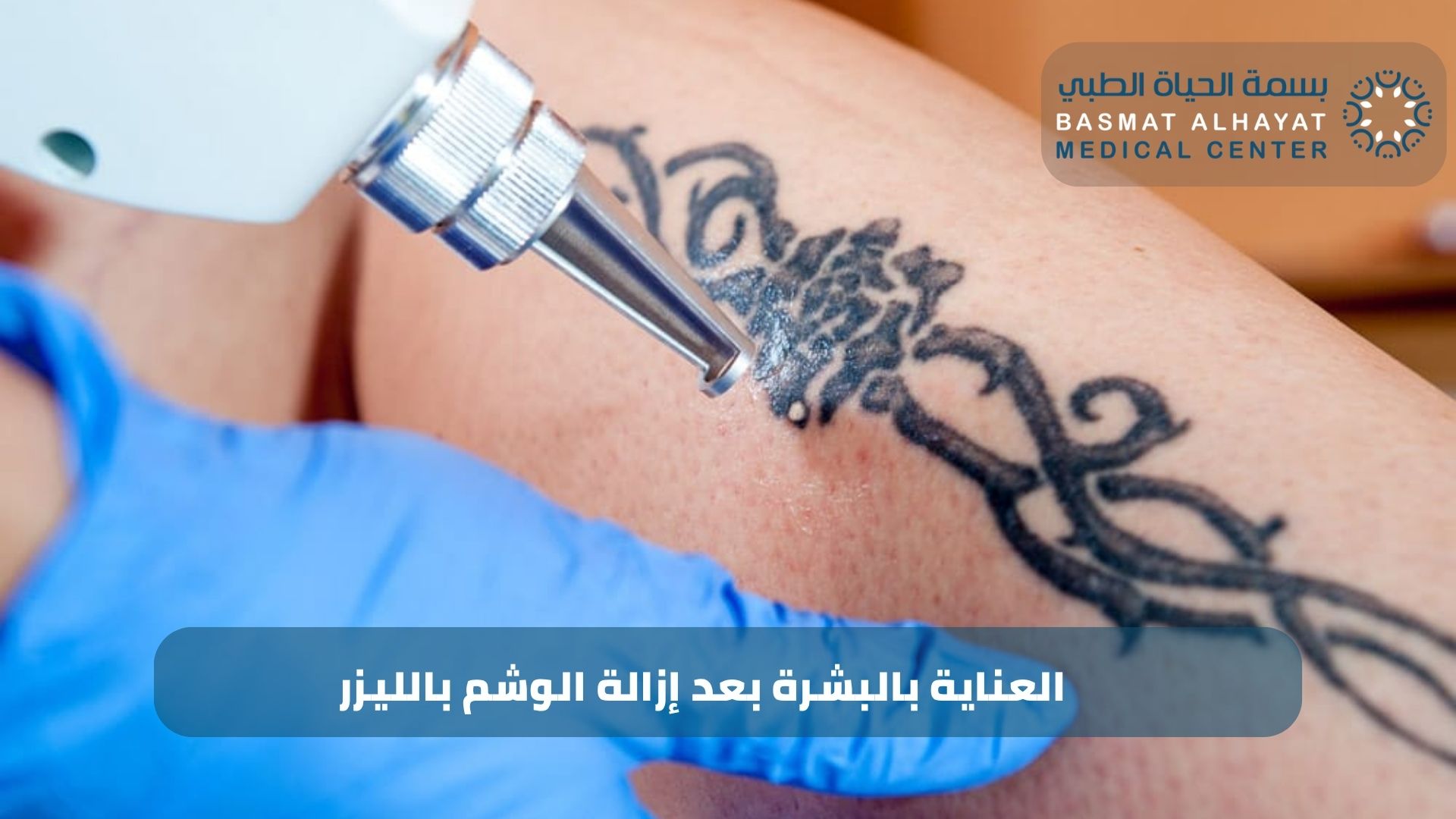 العناية بالبشرة بعد إزالة الوشم بالليزر
