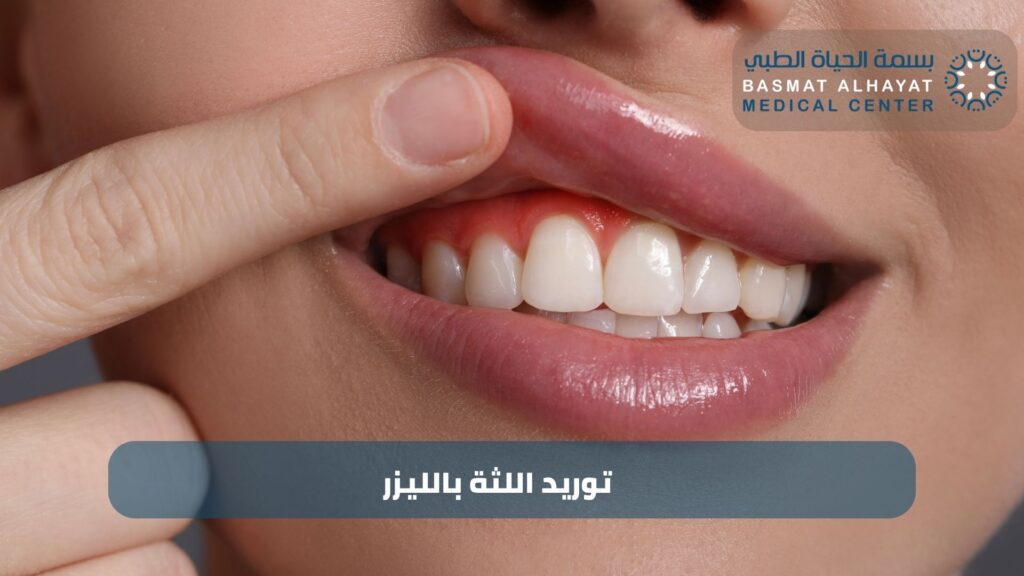 توريد اللثة بالليزر