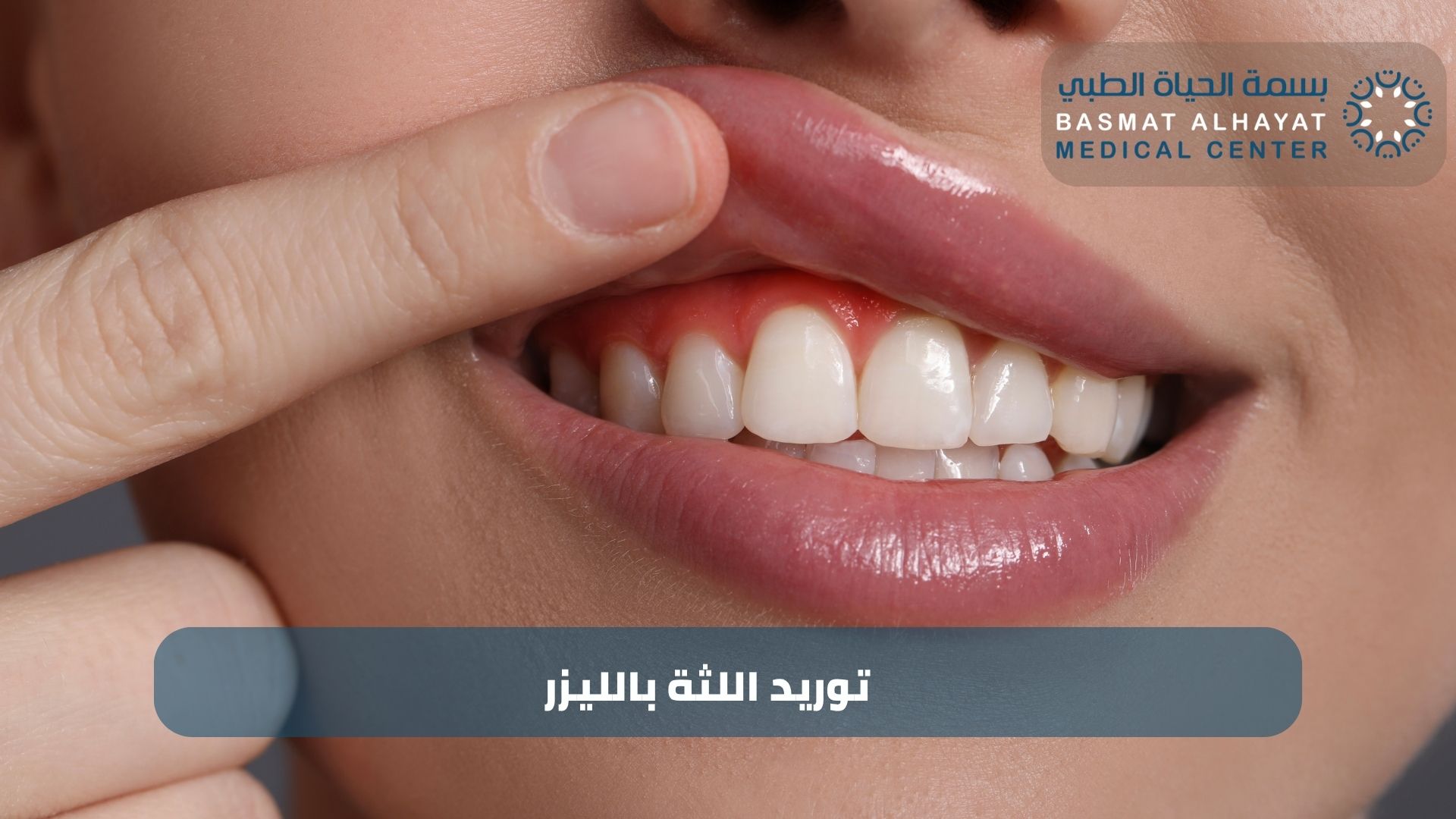 توريد اللثة بالليزر