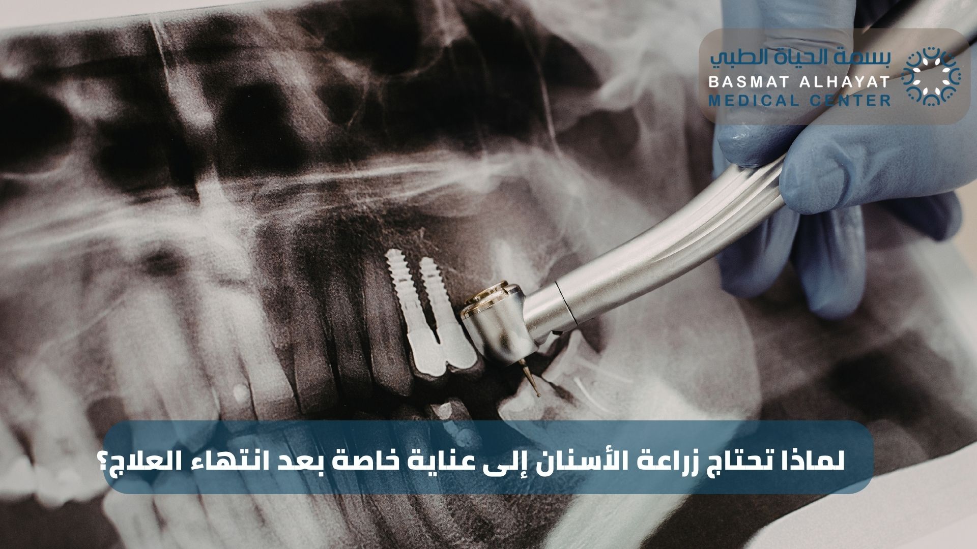 لماذا تحتاج زراعة الأسنان إلى عناية خاصة بعد انتهاء العلاج؟