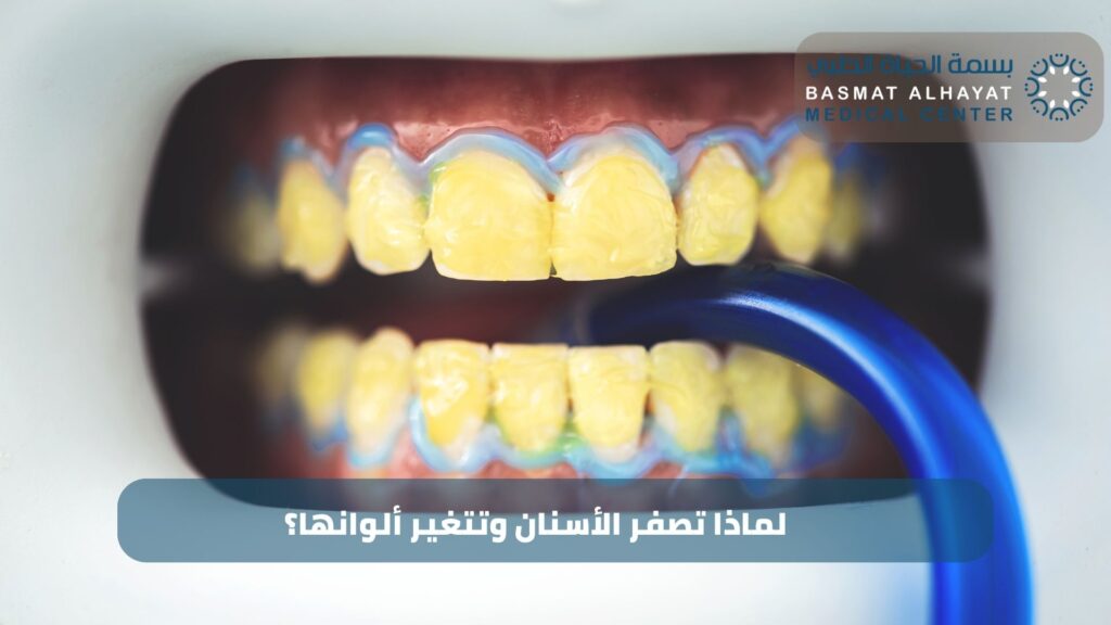 لماذا تصفر الأسنان وتتغير ألوانها؟