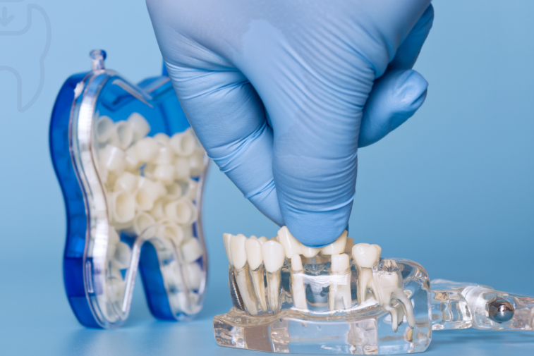 dental-crowns-bridges