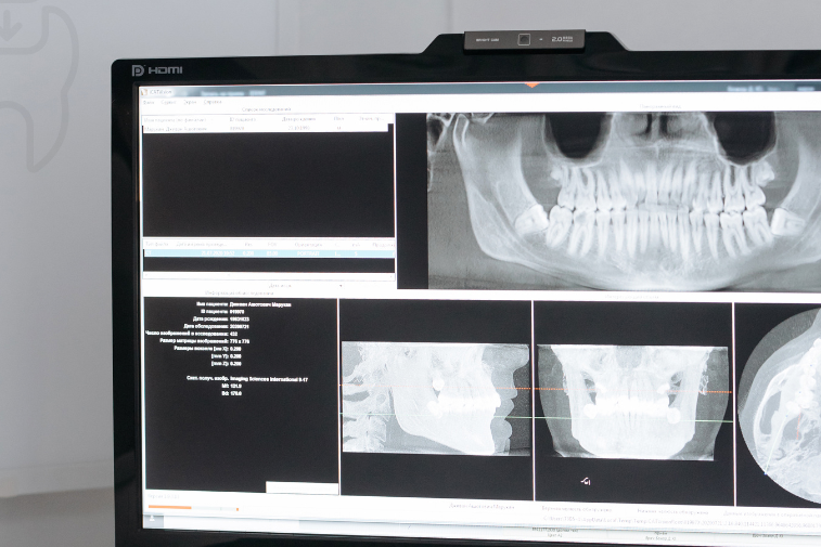 اشعة سينية ( X-ray) لفحص الأسنان