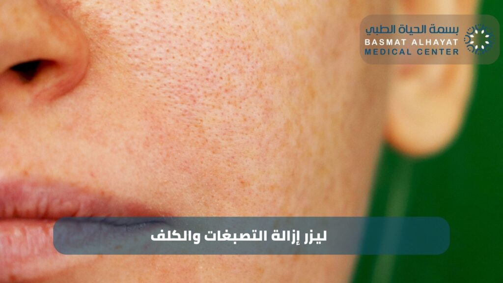 التصبغات والكلف