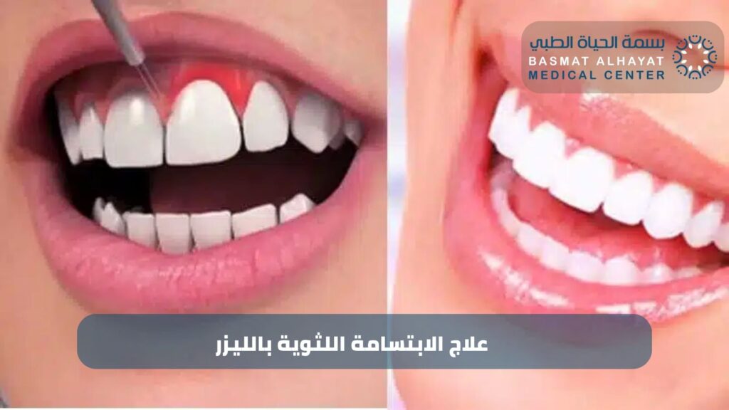 علاج الابتسامة اللثوية بالليزر
