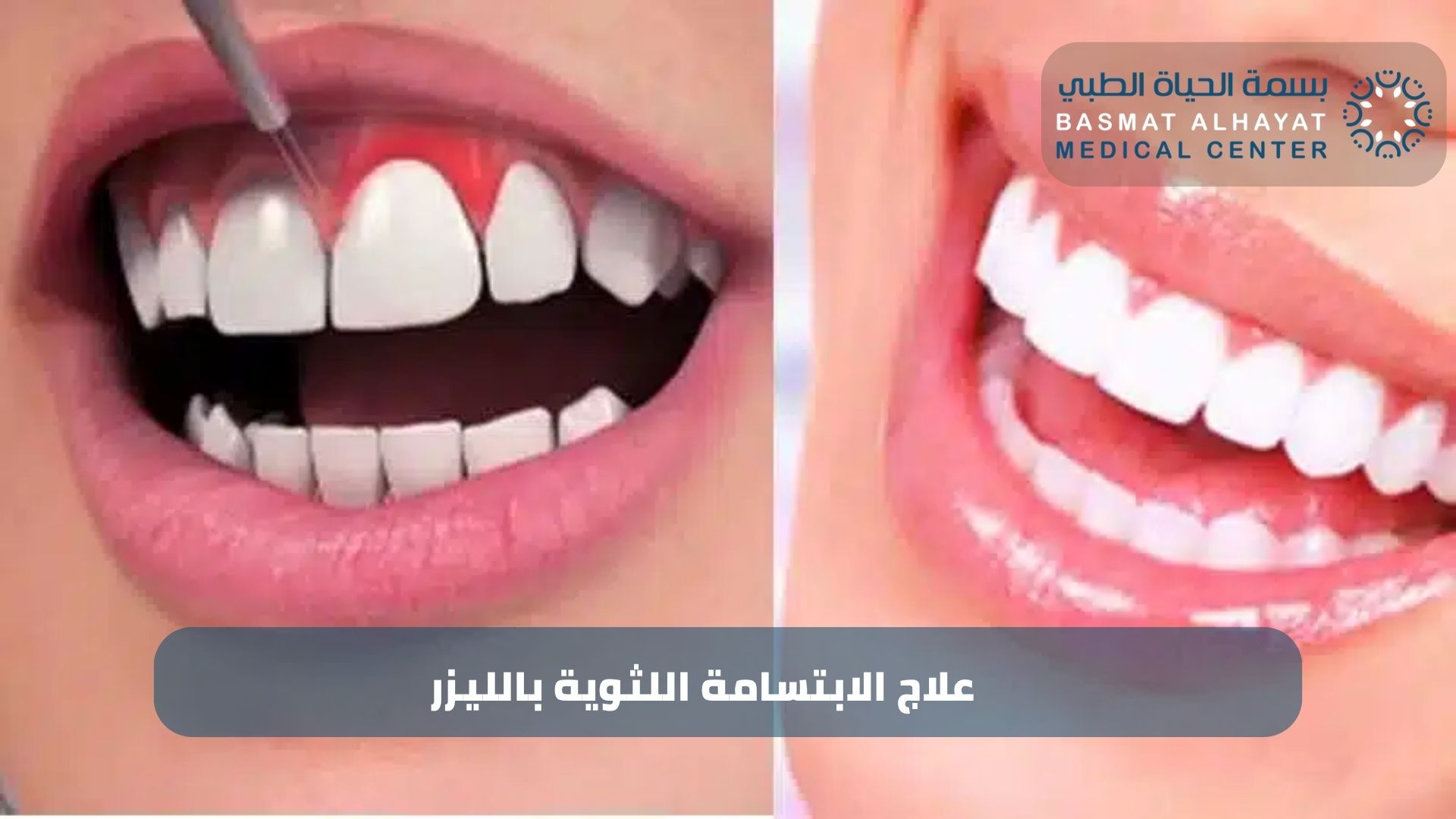 علاج الابتسامة اللثوية بالليزر