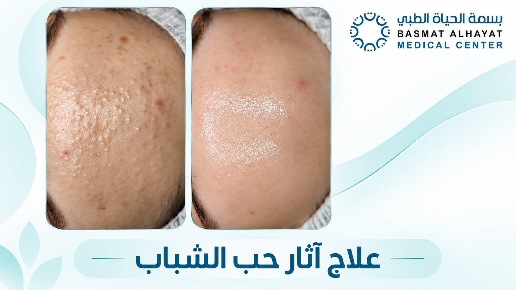علاج آثار حب الشباب قبل وبعد - بسمة الحياة الطبي