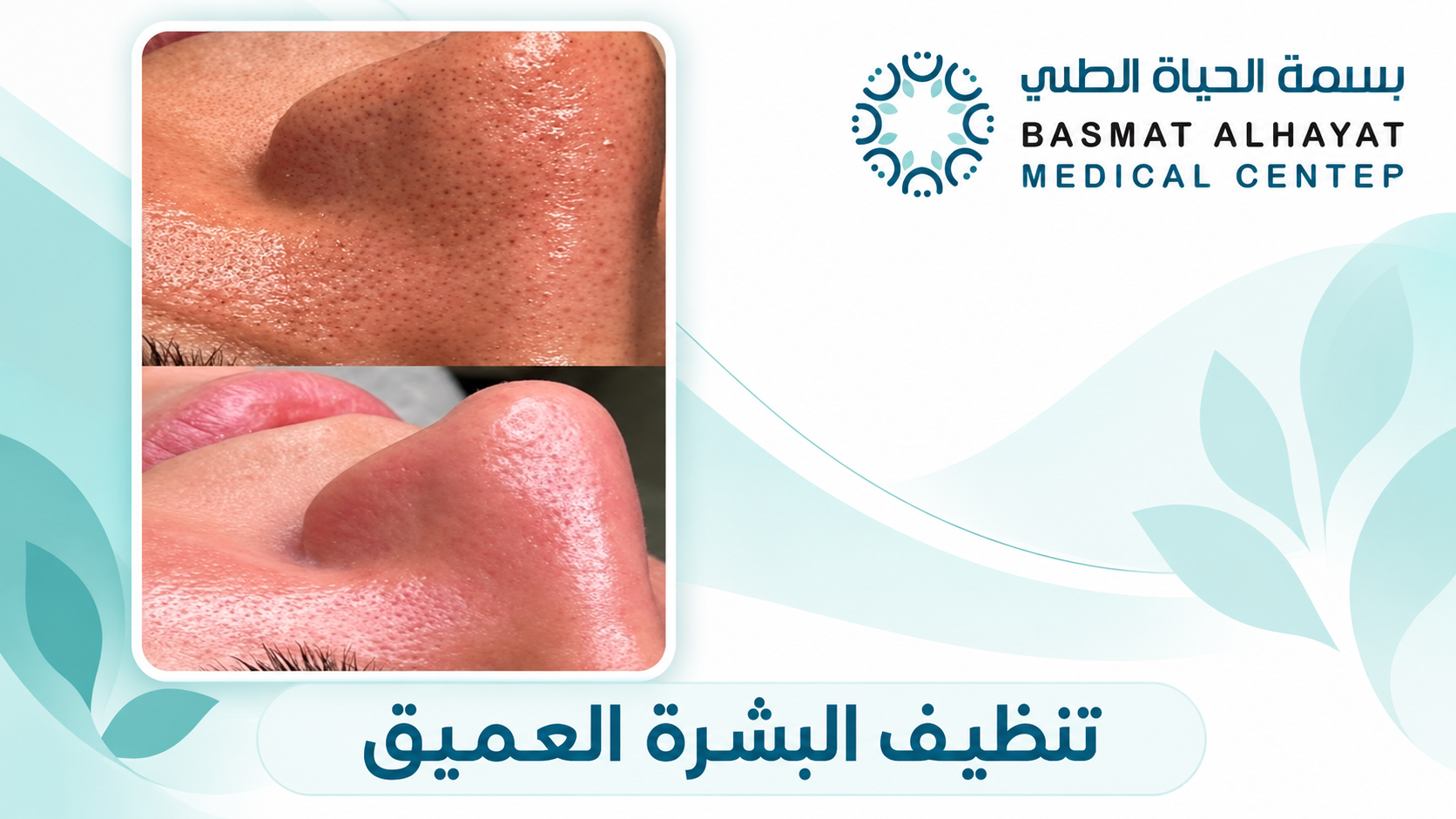 تنظيف البشرة العميق قبل وبعد - بسمة الحياة الطبي