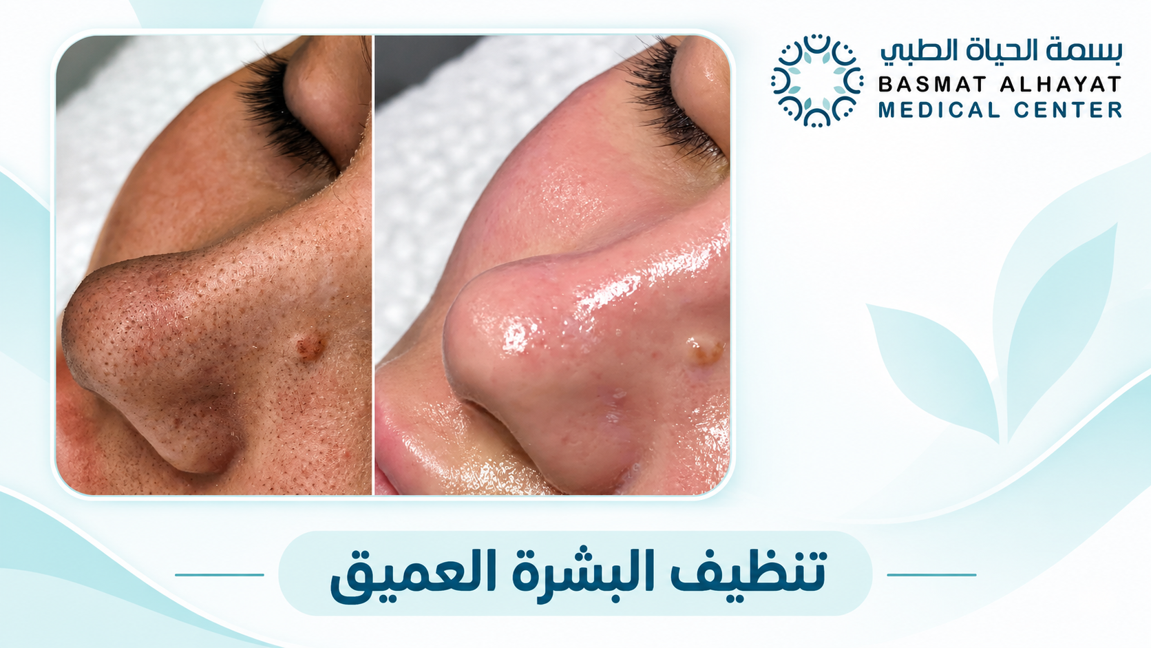 تنظيف البشرة العميق قبل وبعد في رأس الخيمة - بسمة الحياة الطبي
