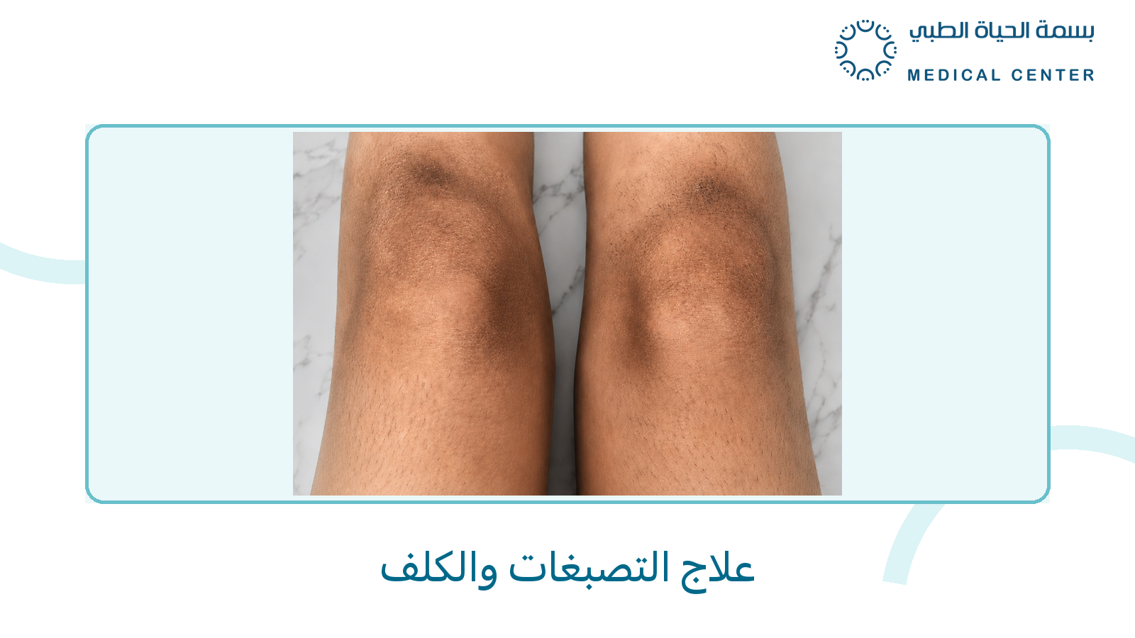علاج التصبغات والكلف - بسمة الحياة الطبي