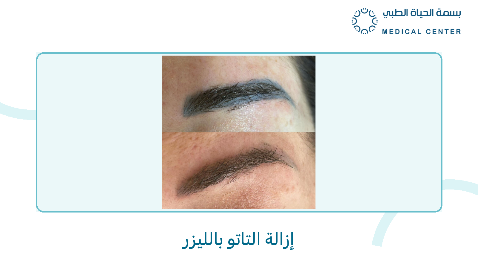 إزالة التاتو بالليزر - بسمة الحياة الطبي