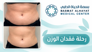 رحلة فقدان الوزن قبل وبعد - بسمة الحياة الطبي