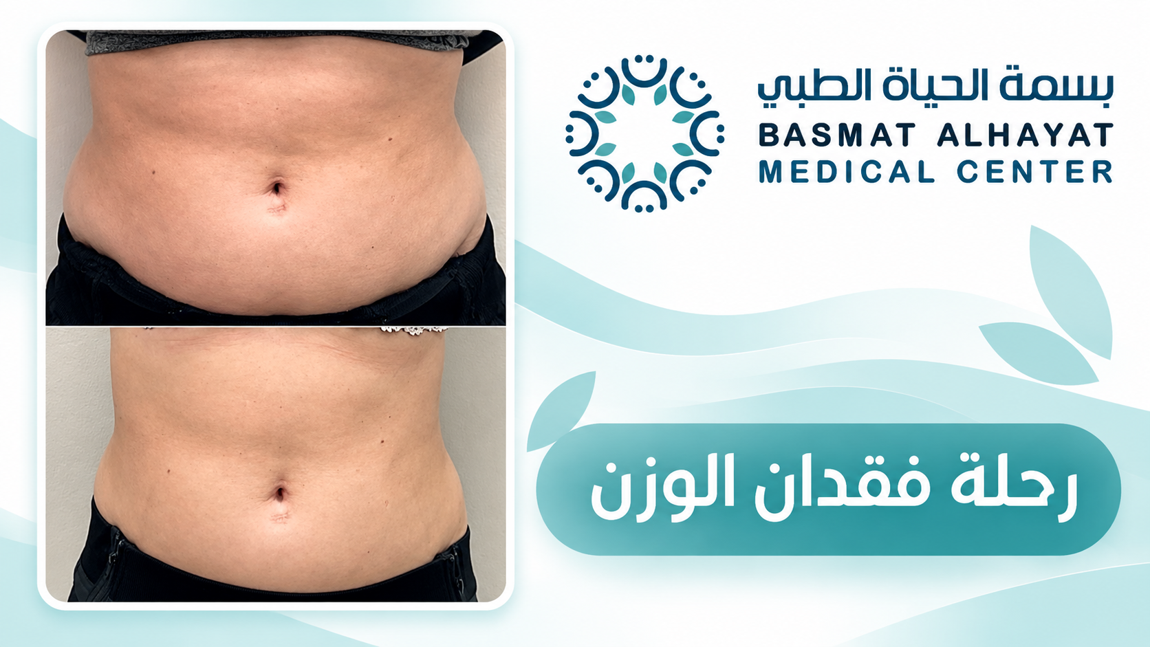 رحلة فقدان الوزن قبل وبعد - بسمة الحياة الطبي