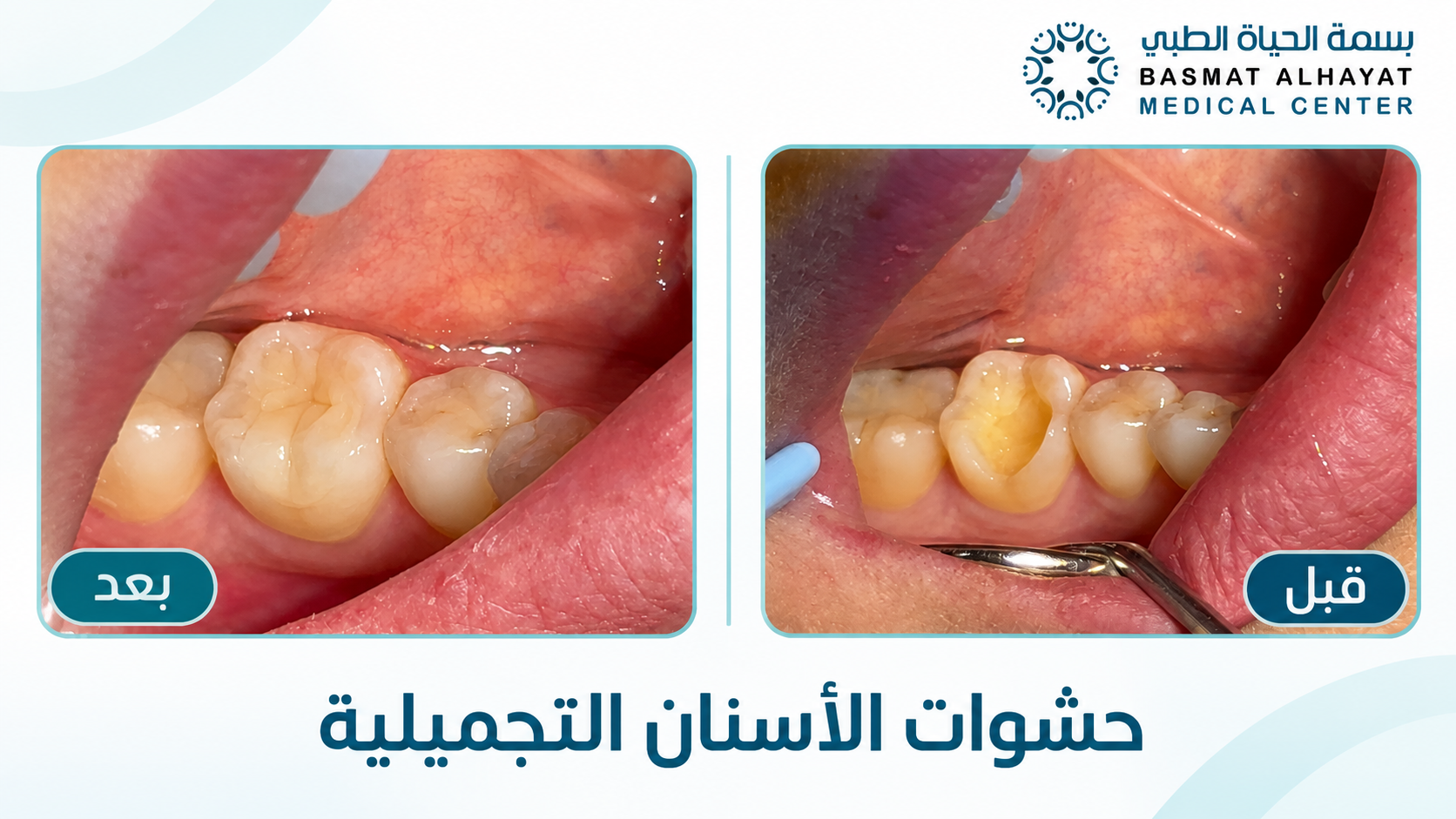 حشوات الأسنان التجميلية قبل وبعد في مركز بسمة الحياة