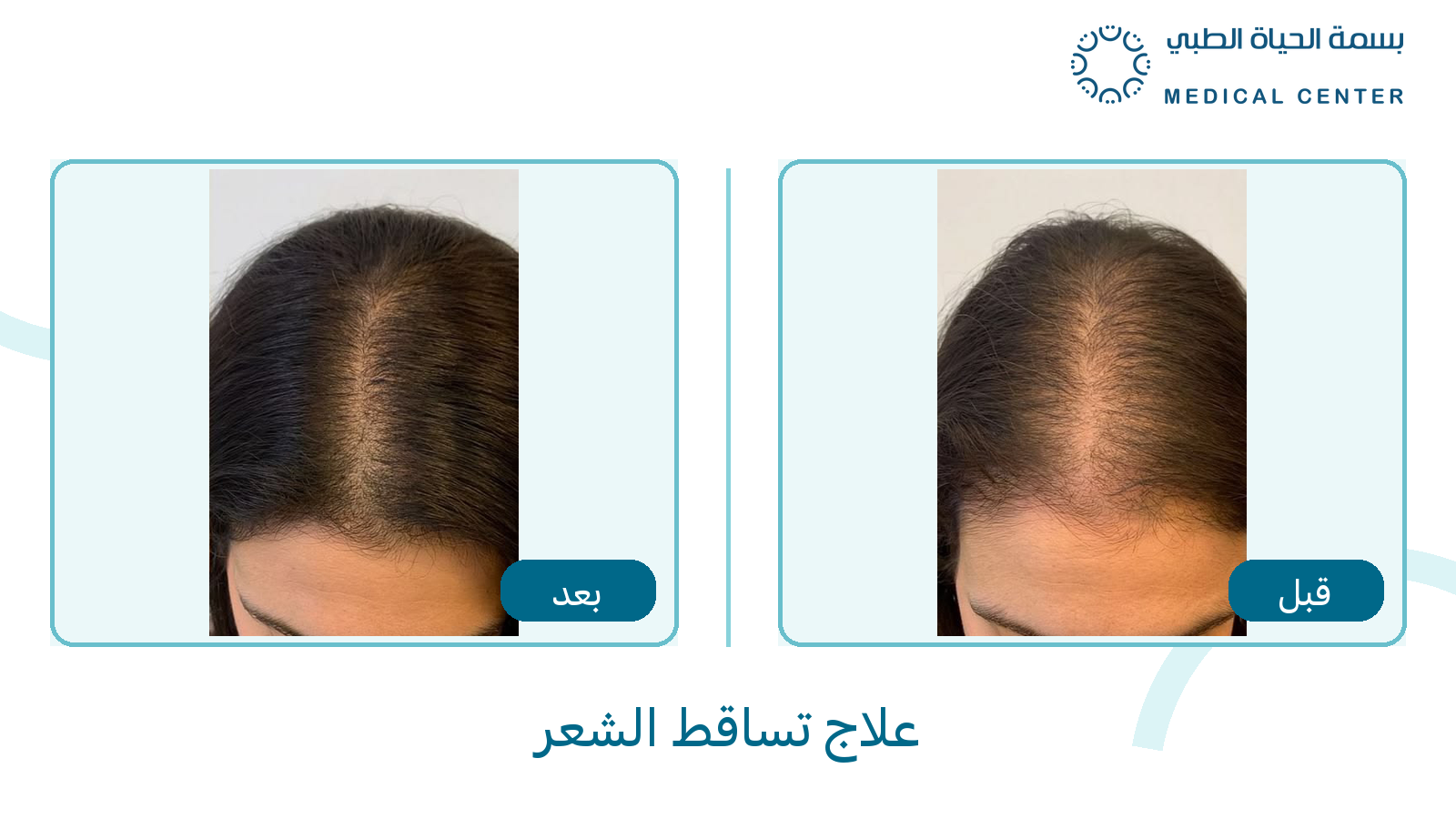 علاج تساقط الشعر قبل وبعد في مركز بسمة الحياة