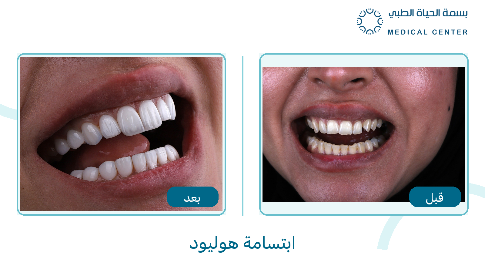 ابتسامة هوليود قبل وبعد في مركز بسمة الحياة