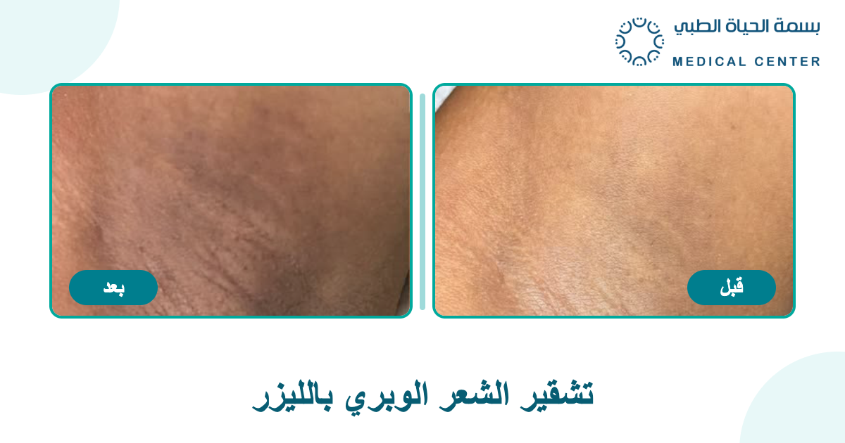 صورة قبل وبعد توضيحية لعناية البشرة