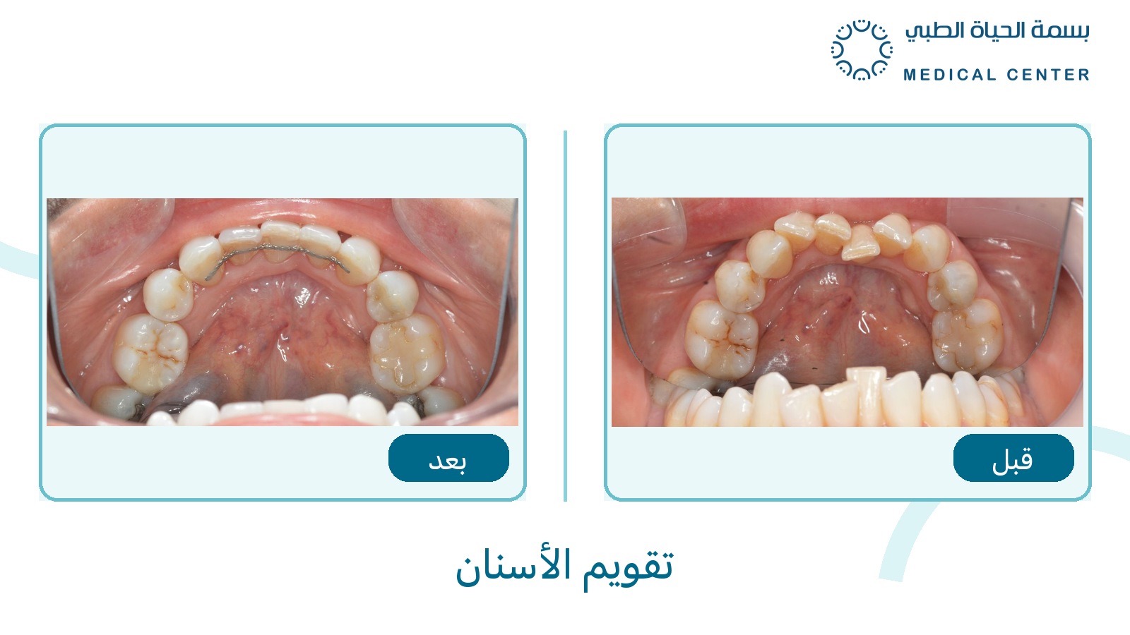 تقويم الأسنان قبل وبعد في مركز بسمة الحياة